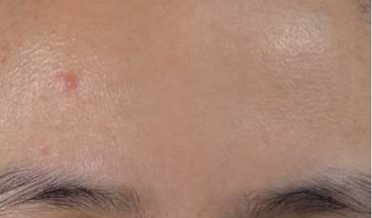 spot acne